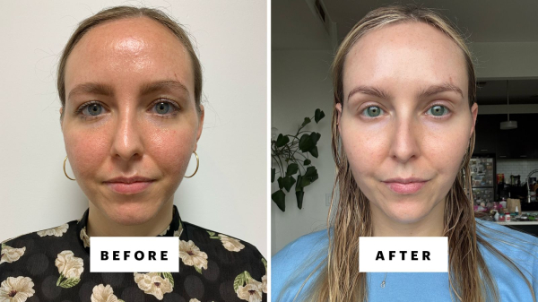 A before and after image side by side of Allure editor Sarah Kinonen before using azelaic acid and tretinoin and after.